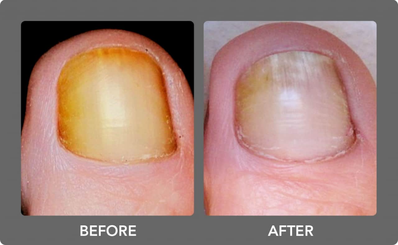 Keryflex™ Nail Restoration System - Allentown Family Foot Care